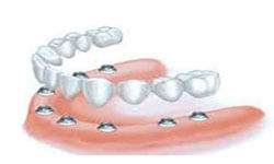 Illustration of an All-on-Eight implant-supported denture being placed in the lower jaw by Premier Holistic Dental in beautiful Costa Rica.  The illustration shows how an all-on-eight denture is attached to eight dental implants