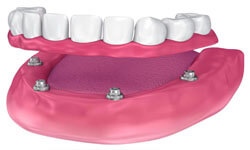 Illustration of an All-on-Four implant-supported denture being placed in the lower jaw by Premier Holistic Dental in beautiful Costa Rica.  The illustration shows how the All-on-Four denture attaches to four implants.
