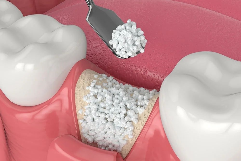 Picture of bone graft material being placed in an empty socket at the world famous Premier Holistic Dental in San Jose, Costa Rica.  The material is a white grainy powder, and is being packed tightly into an empty tooth socket in-between 2 normal teeth.