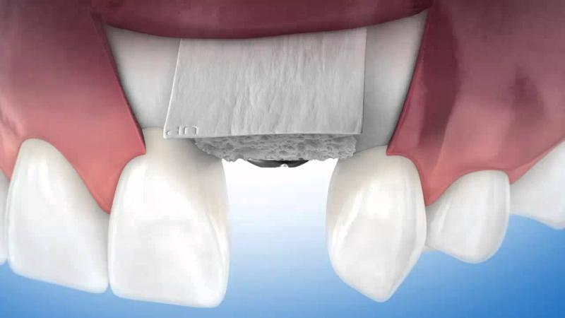 Picture of a missing tooth socket in line with other teeth, and showing how a bone graft is placed in the missing socket at the world famous Premier Holistic Dental in San Jose, Costa Rica.  The picture shows 5 teeth in a row, one missing socket, and a bone graft being placed in the empty socket.