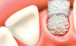 Illustration of a dental bone graft procedure in the lower jaw as done by Premier Holistic Dental in beautiful Costa Rica.  The illustration shows filling a tooth socket with bone graft material.