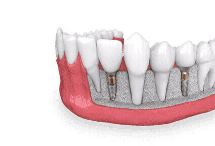 Illustration of an all-on-two procedure done in Costa Rica.