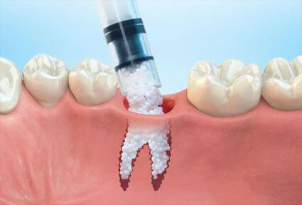 Illustration of a bone grafts procedure done in Costa Rica.