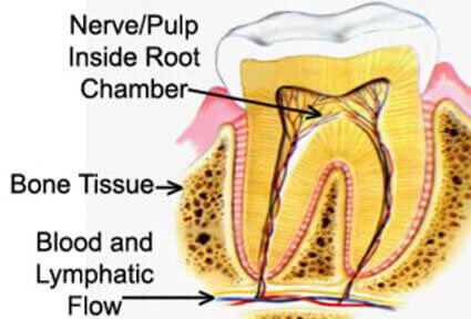 Illustration of a dental cavitation procedure, showing how it is  done in Costa Rica.