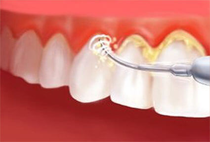 Illustration of four teeth showing how a dental cleaning procedure is done in Costa Rica