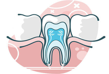 Illustration of a tooth in the lower jaw, showing how an endodontics procedure is done in Costa Rica.