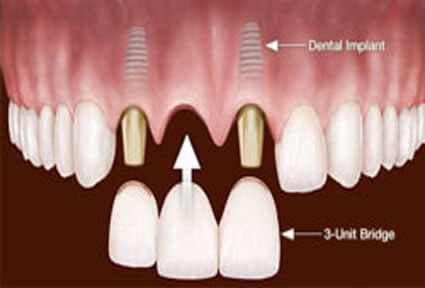 Illustration of implant-supported bridges done in Costa Rica.