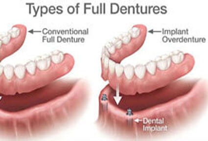 Illustration of implant-supported dentures done in Costa Rica.