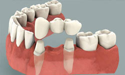 Illustration of a three unit dental bridge being placed in the lower jaw by Premier Holistic Dental in London.