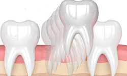 Illustration of a Holistic Dental Extraction being performed in the lower jaw at Premier Holistic Dental in beautiful Costa Rica.  The illustration shows 3 white teeth in the lower jaw with one of them being extracted.