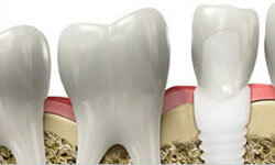 Illustration of a Holistic Dental Implant being placed in the lower jaw by Premier Holistic Dental in beautiful Costa Rica..  The illustration shows 4 teeth on the lower jaw and one of them shows how Premier Holistic places the crown on the post.