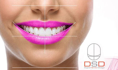 Close-up picture of a smiling young woman happy with her Digital Smile Design (DSD) at Premier Holistic Dental in beautiful Costa Rica.  She is wearing purple lipstick and showing perfect white teeth.