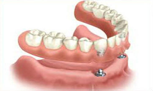 Illustration of an all-on-two implant-supported denture made at Premier Holistic Dental in beautiful Costa Rica.  The illustration shows how the denture is attached to the implants.