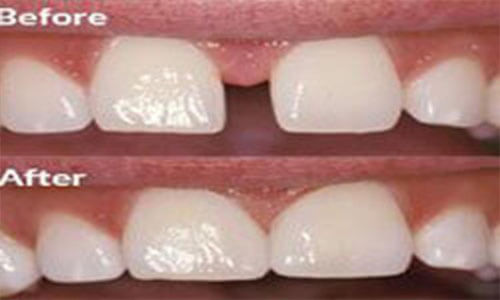 I Illustration of how a bonding procedure is done at Premier Holistic Dental in beautiful Costa Rica..  The illustration shows the front teeth before and after a bonding procedure.