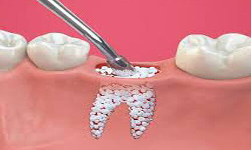 Illustration of a dental sinus lift procedure as done at Premier Holistic Dental in beautiful Costa Rica.  The illustration shows the sinus area above the upper teeth where the dental procedure will be done to support dental implants.