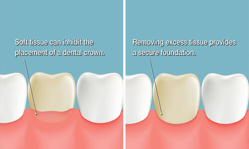 Illustration of a 3 teeth needing a scaling and root planing procedure in Costa Rica. The illustration shows how the lower part of the tooth is scraped to remove plaque.