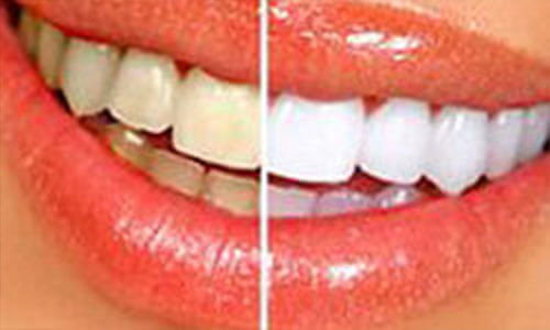 Close-up picture of a smiling woman with perfect teeth, showing her happiness with the dental whitening she had done at Premier Holistic Dental in beautiful Costa Rica.  The picture shows 1/2 of her teeth unwhitened, and the other half whitened.