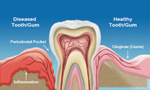 Illustration of a tooth with periodontal disease.  The illustration shows the various parts of an infected tooth and how Premier Holistic Dental in beautiful Costa Rica will treat the problem.
