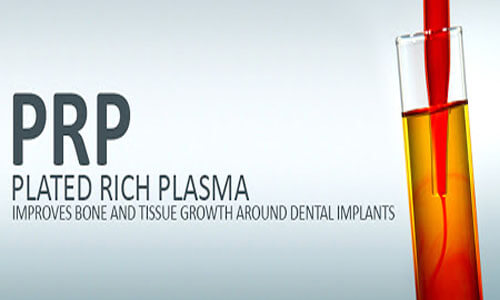 Illustration of the Platelet Rich Plasma (PRP) emblem representing the procedure being done at Premier Holistic Dental in beautiful Costa Rica.  The picture shows a vial of platelet rich plasma.
