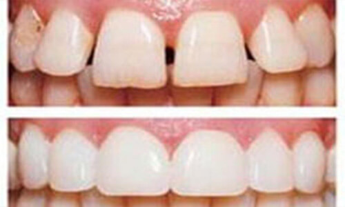 Picture of several dental veneers showing how they are placed over existing teeth.  The picture is of before and after white teeth, and showing how the upper teeth look better with dental veneers.