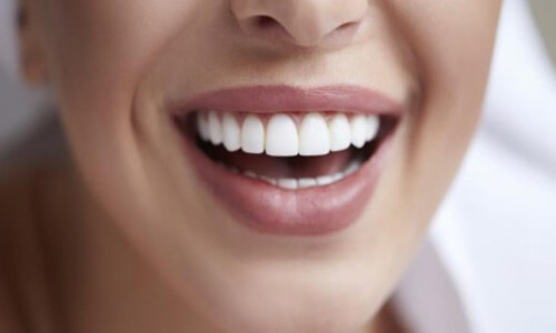 Close up picture of a smiling woman with white perfect teeth showing her happiness with the implant supported denture she received  at Premier Holistic Dental in beautiful Costa Rica.