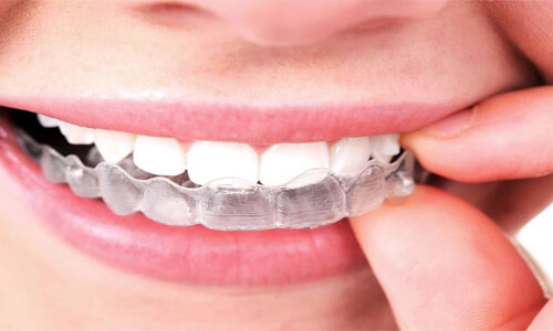 Close-up picture of a smiling young woman, holding Invisible braces near her teeth to show her perfectly aligned white teeth, and happy with her Holistic Invisalign procedure done at Premier Holistic Dental in beautiful Costa Rica.