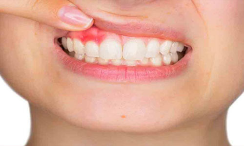 Close-up picture of a woman showing her teeth and gums and displaying a periodontal disease condition that needs to be treated at Premier Holistic Dental in beautiful Costa Rica.  The woman is holding her finger up to the area in the gum that has a periodontal infection.