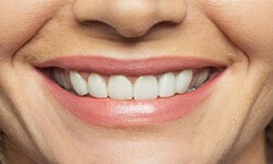 Close-up picture of a smiling woman with perfect teeth showing a Periodontal dental procedure at Premier Holistic Dental in beautiful Costa Rica.