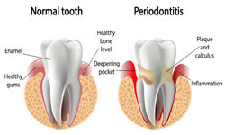 Illustration of a tooth in the lower jaw showing a periodontal treatment by Premier Holistic Dental in beautiful Costa Rica.  The illustration shows a cross section of a normal tooth and another tooth with Periodontitis infection.