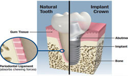 Illustration of a tooth showing Removal Periodontal Ligament at Premier Holistic Dental in beautiful Costa Rica.  The illustration shows a cross section of a tooth and the location of the periodontal ligament.