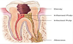 Illustration of a Holistic Root Canal being performed in the upper  jaw by Premier Holistic Dental in beautiful Costa Rica.  The illustration shows a cross-section of the decay, pulp and roots of a tooth