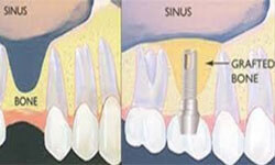 Illustration of how a Sinus Lift is performed in the upper jaw at Premier Holistic Dental in beautiful Costa Rica.  The illustration shows before and after the grafting material being placed in the sinus area.