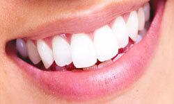 Close-up picture of a smiling woman showing a Dental Whitening procedure at Premier Holistic Dental in beautiful Costa Rica.  The picture shows perfect, white upper teeth.