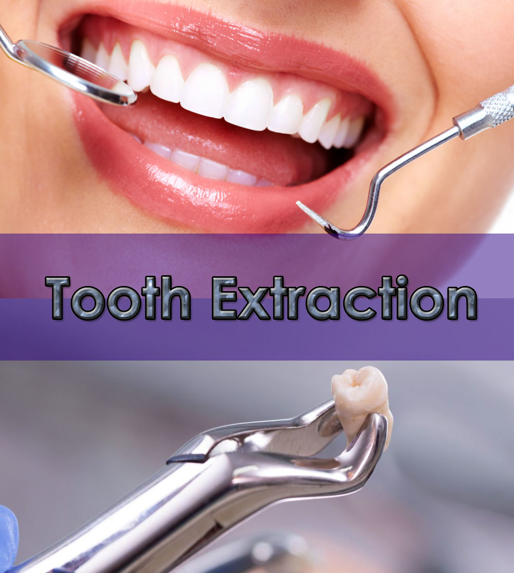 Picture of a how a holistic dental extraction is done at the world famous Premier Holistic Dental in San Jose, Costa Rica